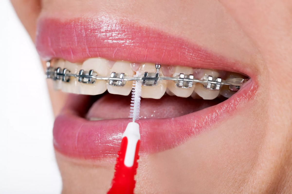 10 Lingual Braces Truths That No Orthodontist Wants You To Know